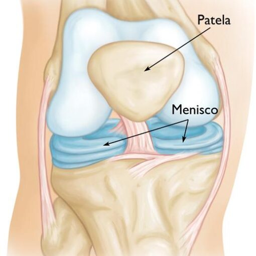 Cirurgia de menisco