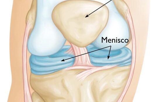 Cirurgia de menisco