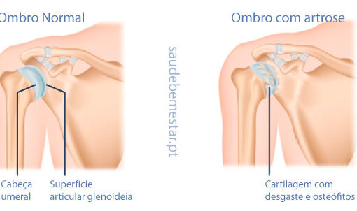Tratamento para artrose no ombro