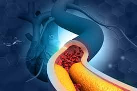 Doença Arterial Coronária