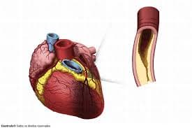 Infarto do Miocárdio