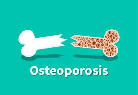 Reumatologista que trata Osteoporose